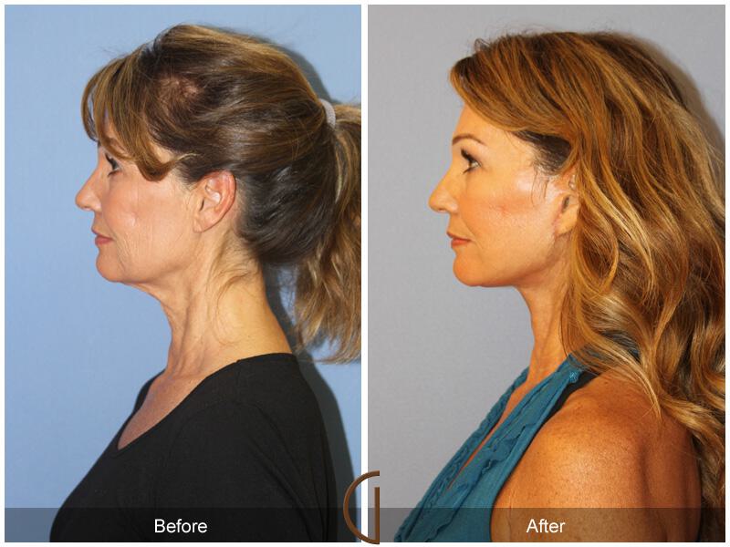 Facelift Fifties Before & After Photo