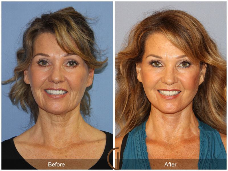 Facelift Fifties Before & After Photo