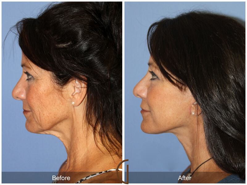 Facelift Fifties Before & After Photo