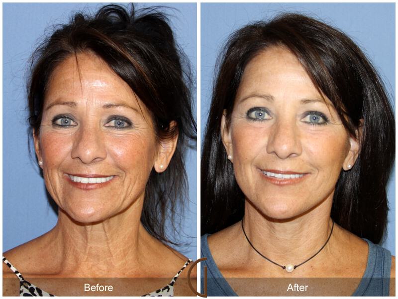 Facelift Fifties Before & After Photo