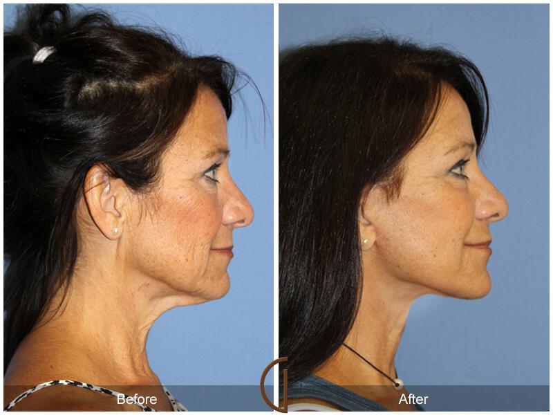 Facelift Fifties Before & After Photo