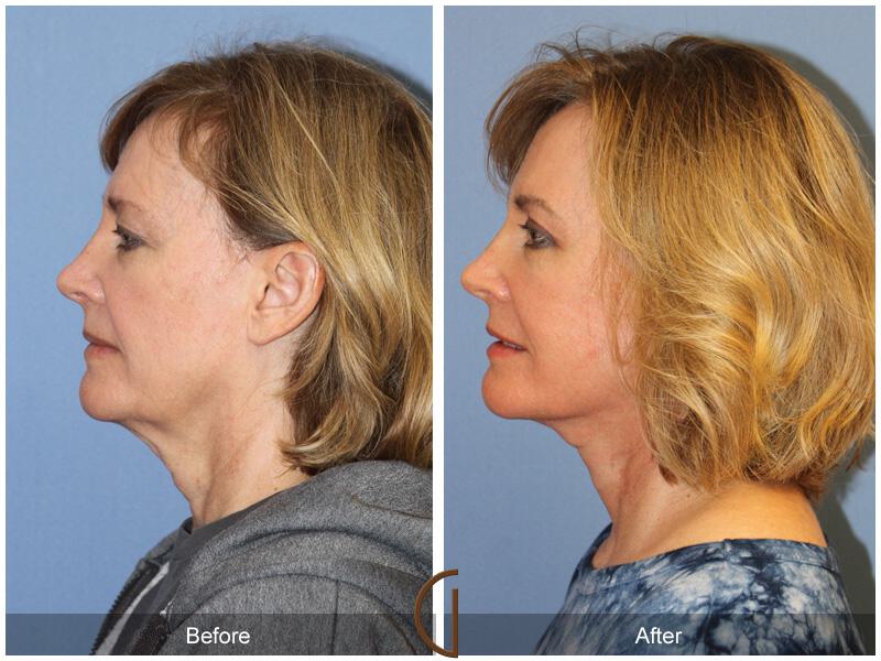 Facelift Fifties Before & After Photo