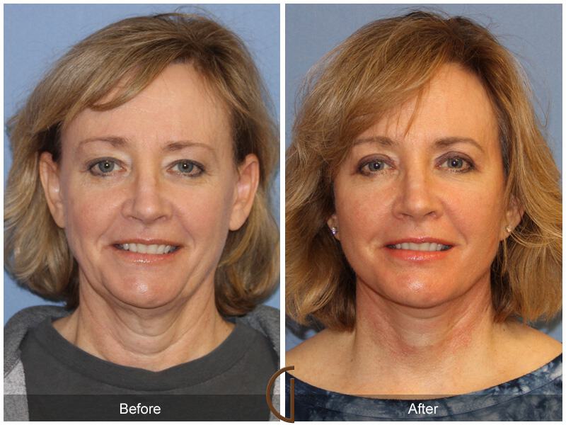 Facelift Fifties Before & After Photo