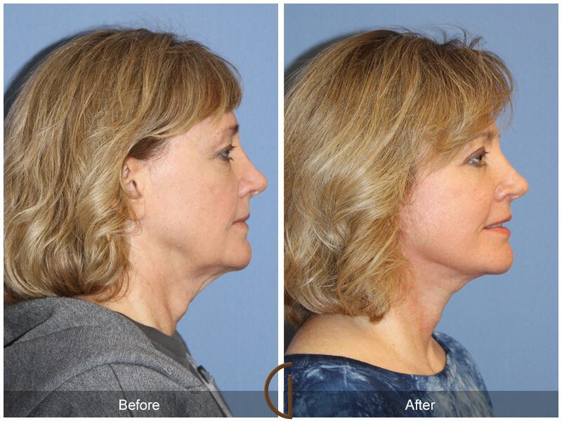 Facelift Fifties Before & After Photo