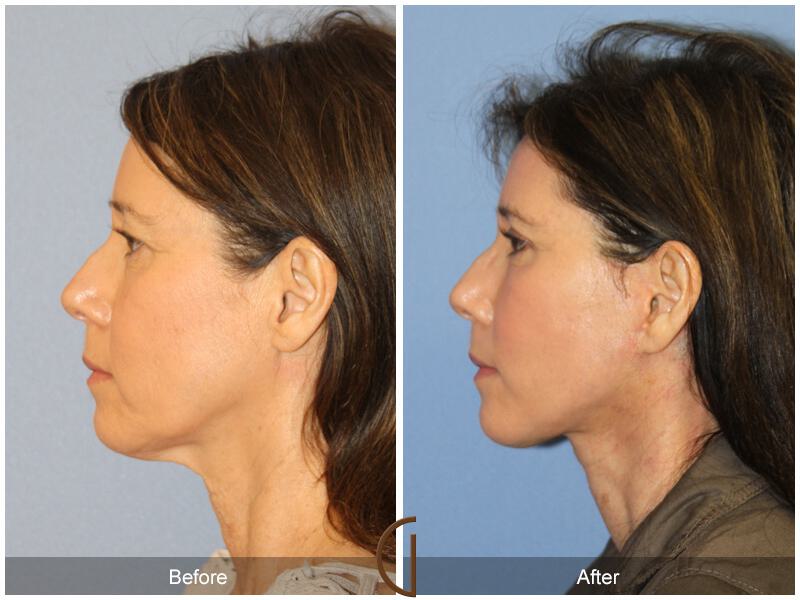 Facelift Fifties Before & After Photo