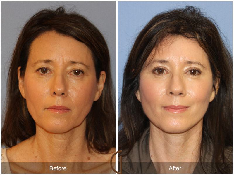 Facelift Fifties Before & After Photo