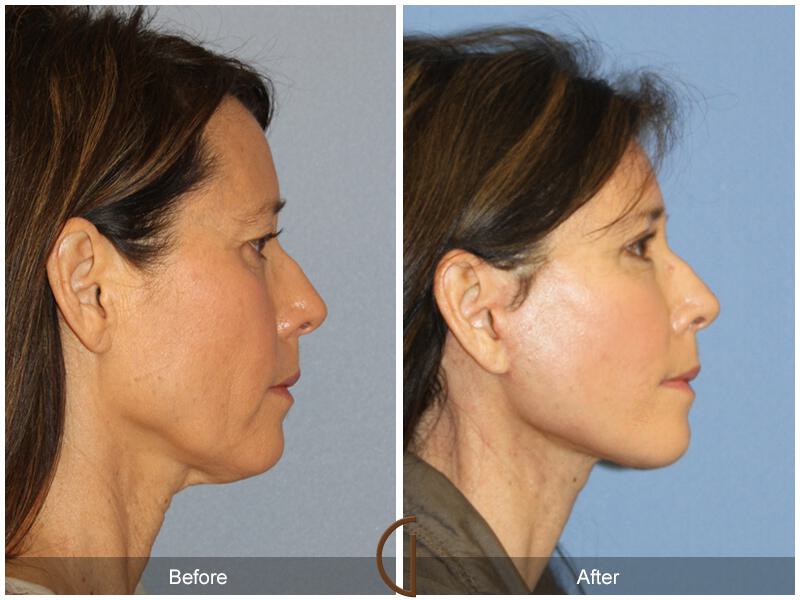 Facelift Fifties Before & After Photo