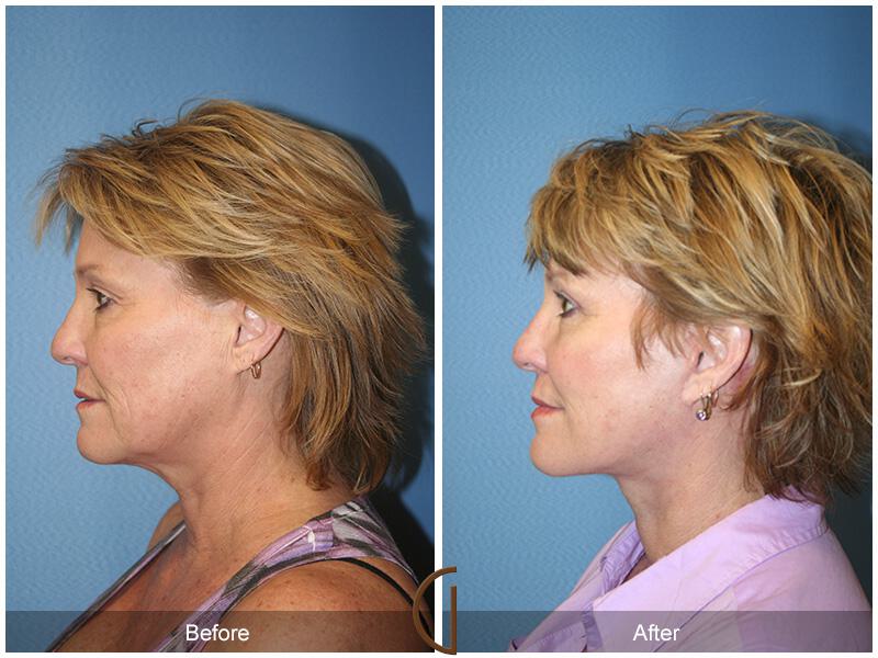 Facelift Fifties Before & After Photo