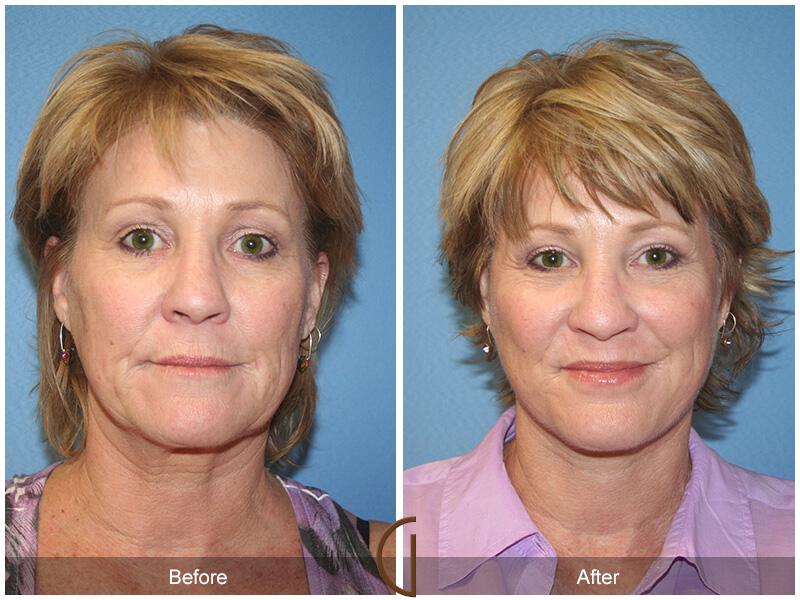 Facelift Fifties Before & After Photo