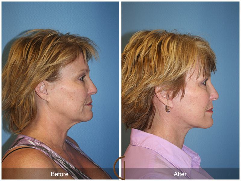 Facelift Fifties Before & After Photo