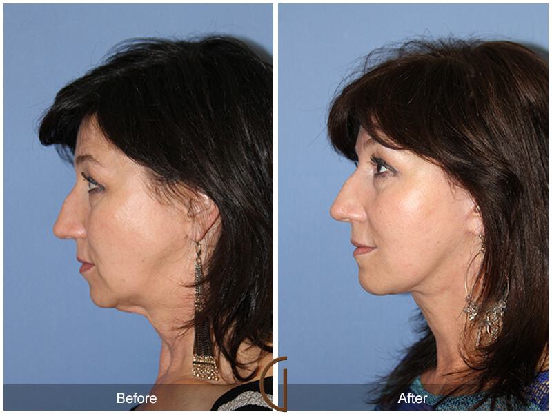 Facelift Fifties Before & After Photo