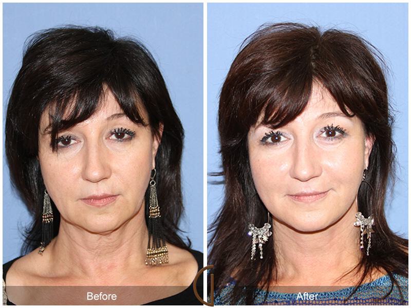 Facelift Fifties Before & After Photo