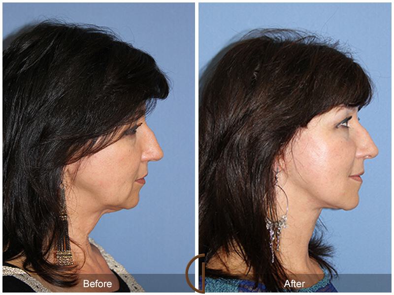 Facelift Fifties Before & After Photo