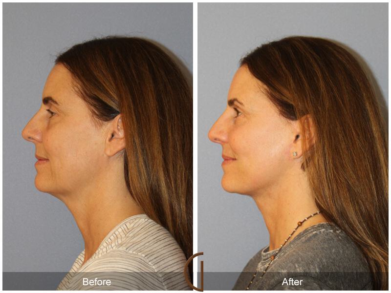 Facelift Fifties Before & After Photo