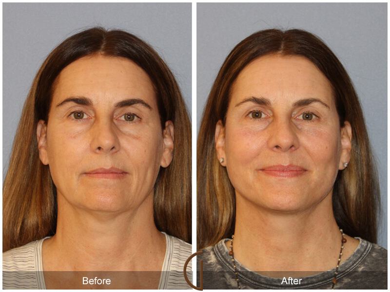 Facelift Fifties Before & After Photo