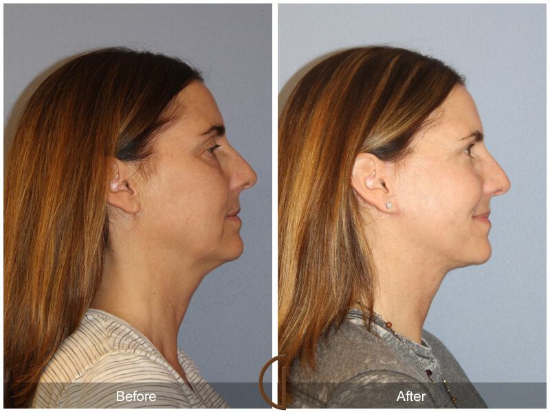 Facelift Fifties Before & After Photo