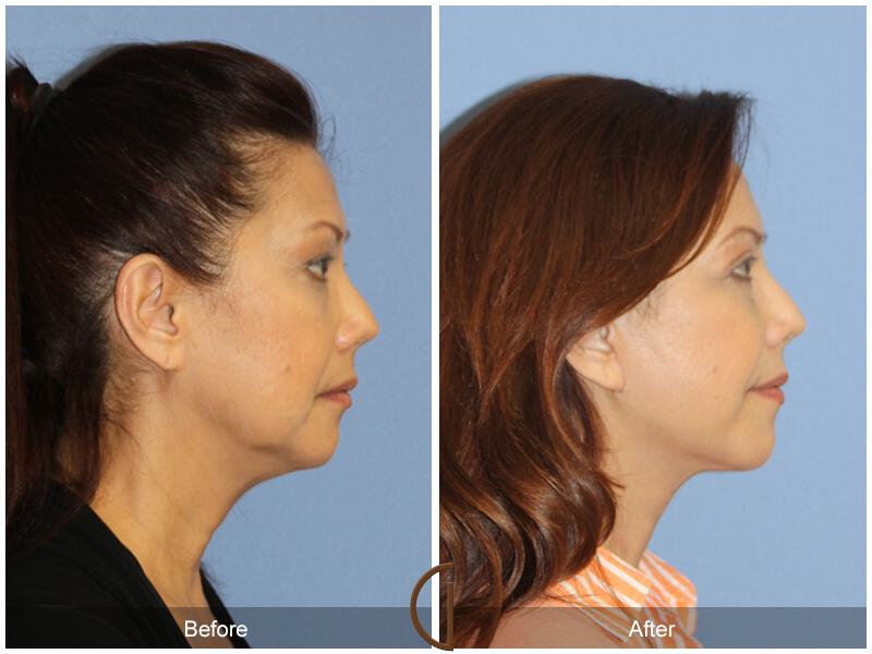 Facelift Fifties Before & After Photo