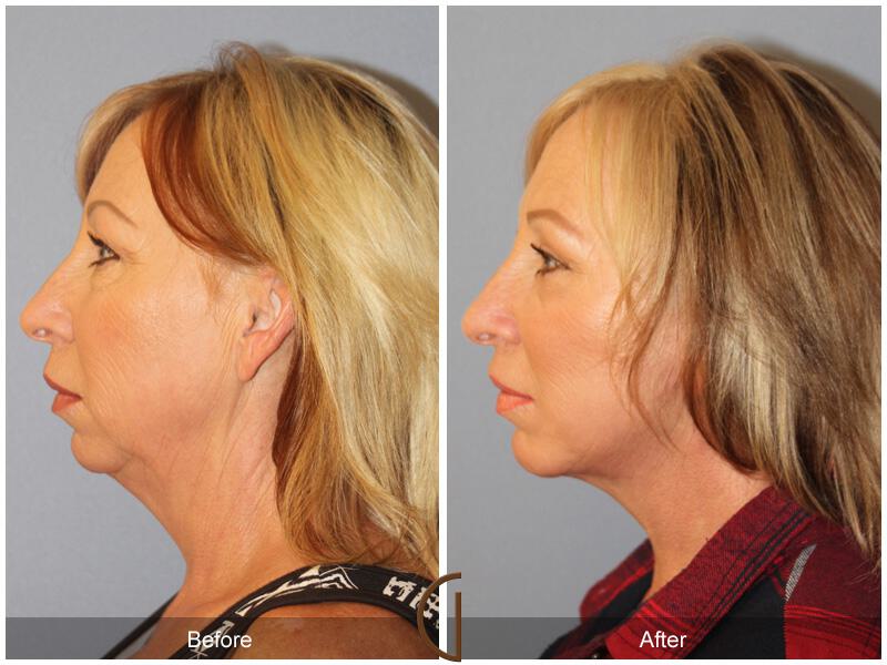 Facelift Fifties Before & After Photo