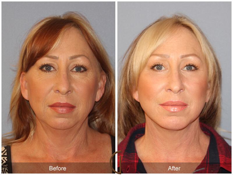 Facelift Fifties Before & After Photo