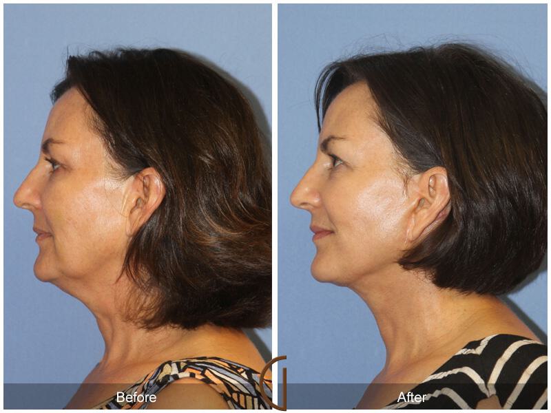 Facelift Fifties Before & After Photo