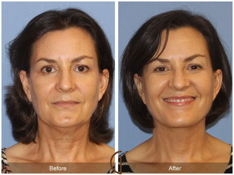 Facelift Fifties Before & After Photo