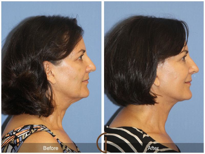 Facelift Fifties Before & After Photo