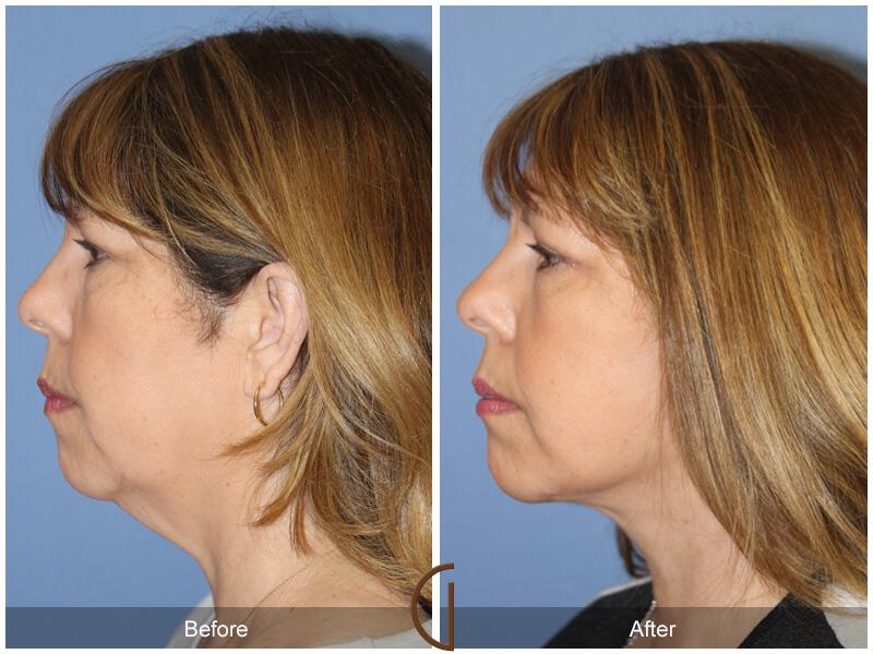 Facelift Fifties Before & After Photo