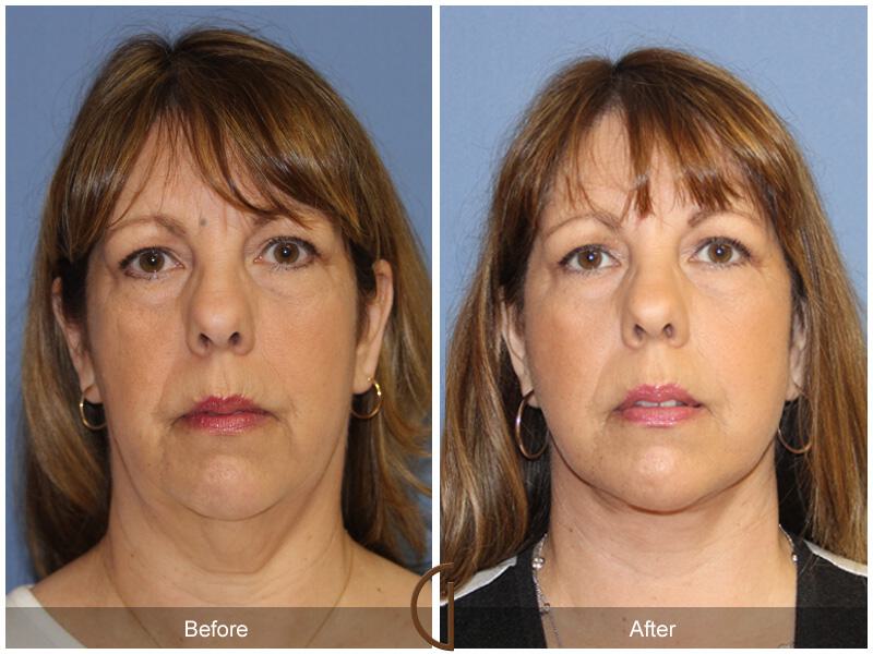 Facelift Fifties Before & After Photo