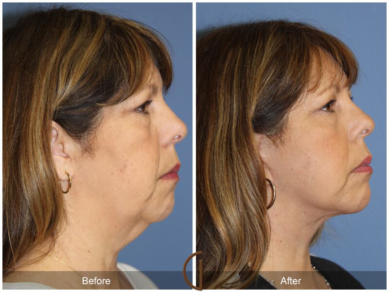 Facelift Fifties Before & After Photo