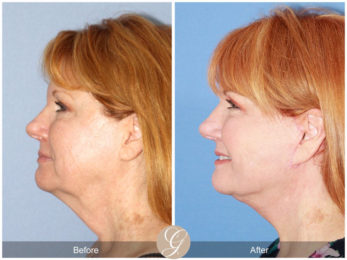 Facelift Fifties Before & After Photo