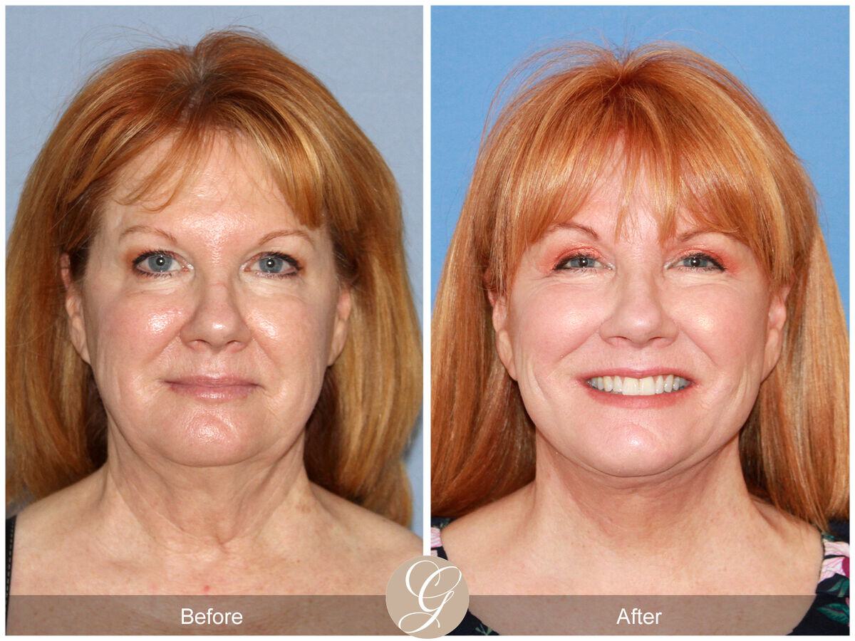 Facelift Fifties Before & After Photo