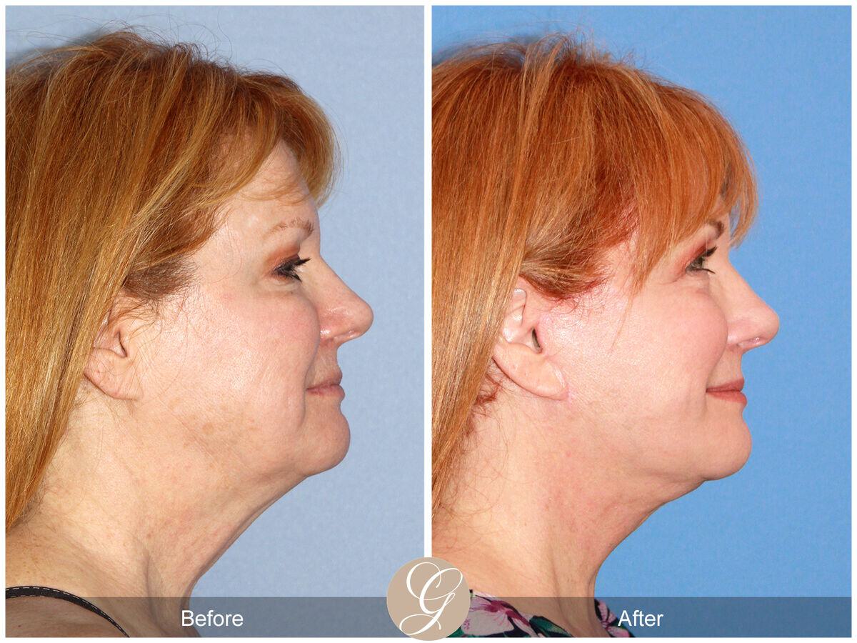 Facelift Fifties Before & After Photo