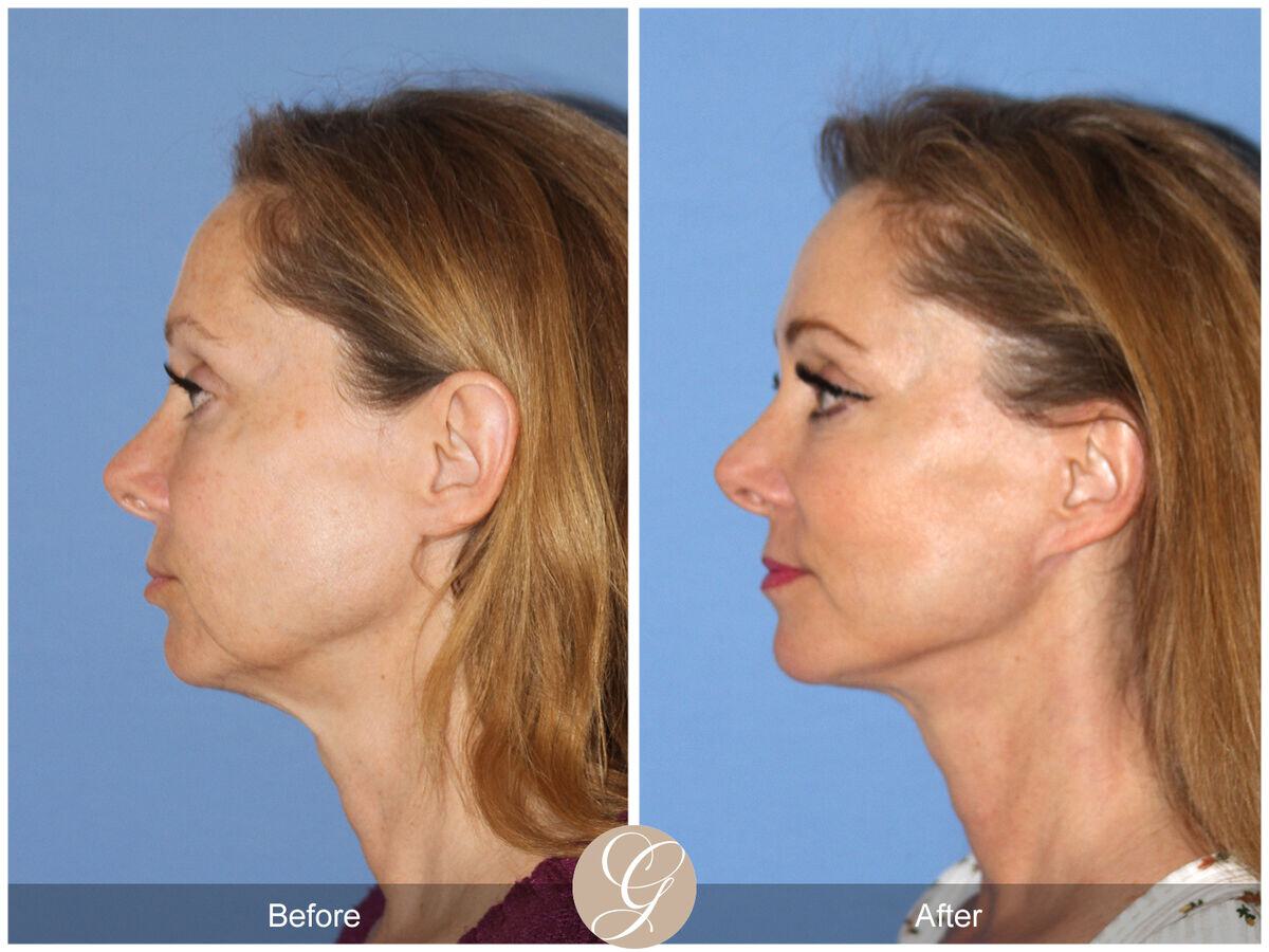 Facelift Fifties Before & After Photo