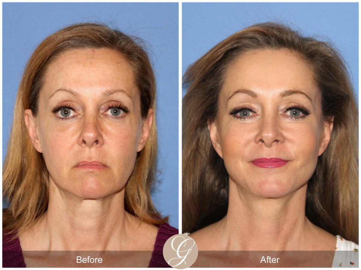 Facelift Fifties Before & After Photo