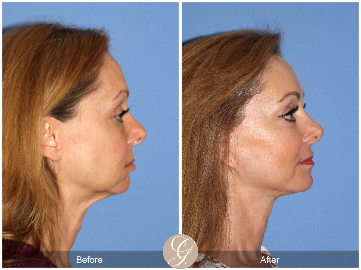 Facelift Fifties Before & After Photo