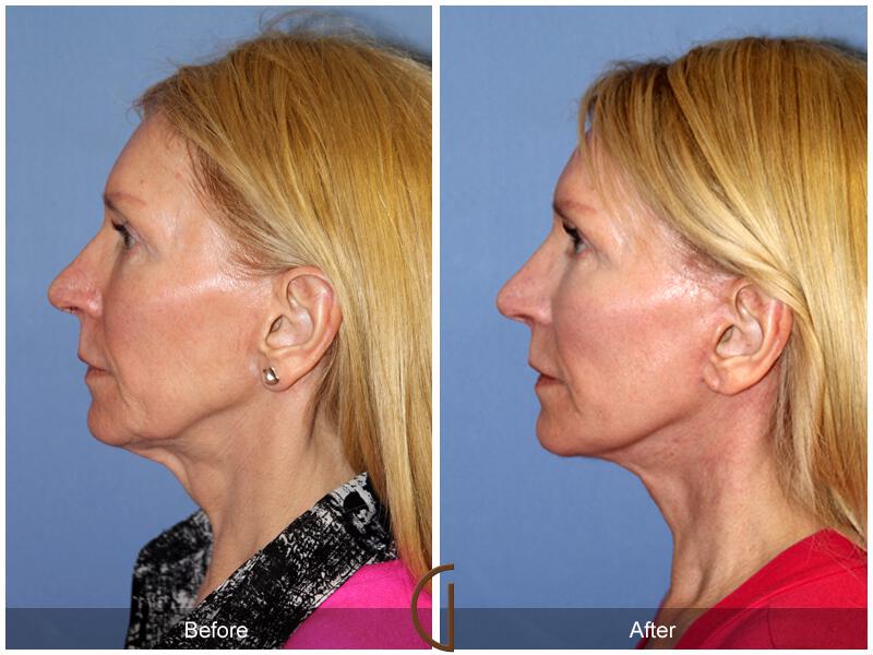 Facelift Fifties Before & After Photo