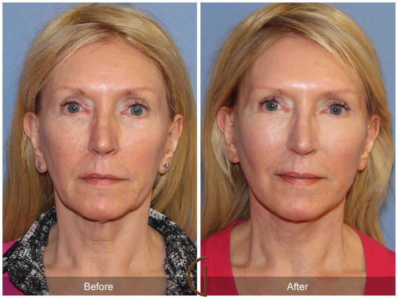 Facelift Fifties Before & After Photo