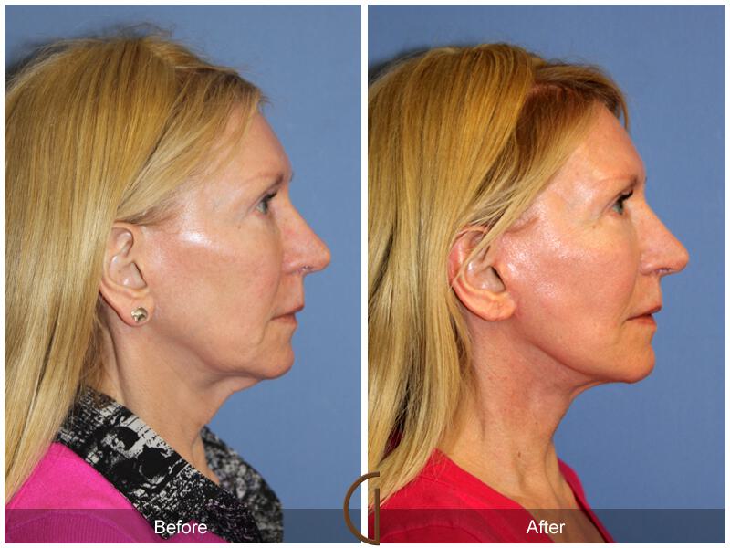 Facelift Fifties Before & After Photo