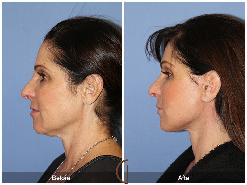 Facelift Fifties Before & After Photo