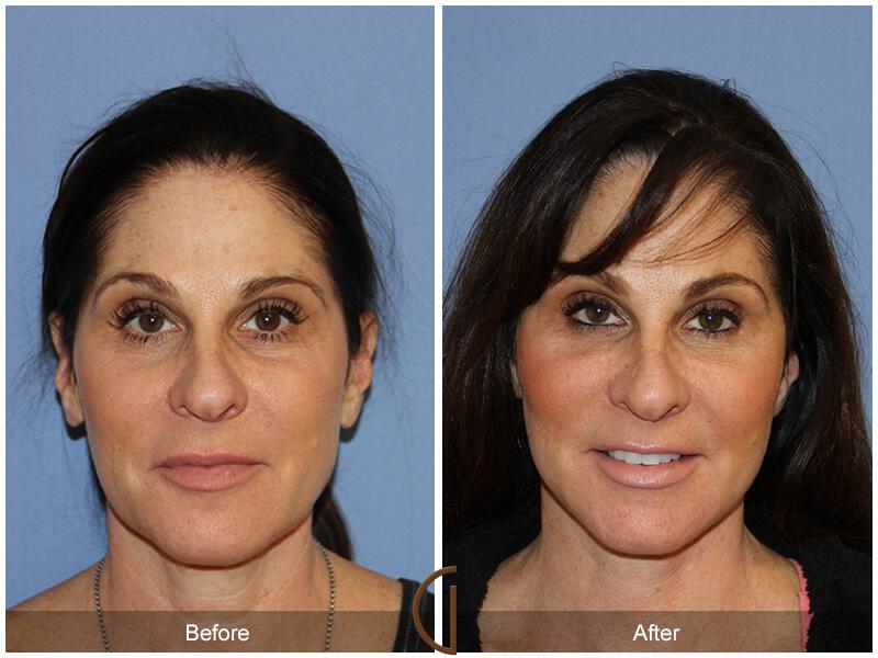 Facelift Fifties Before & After Photo