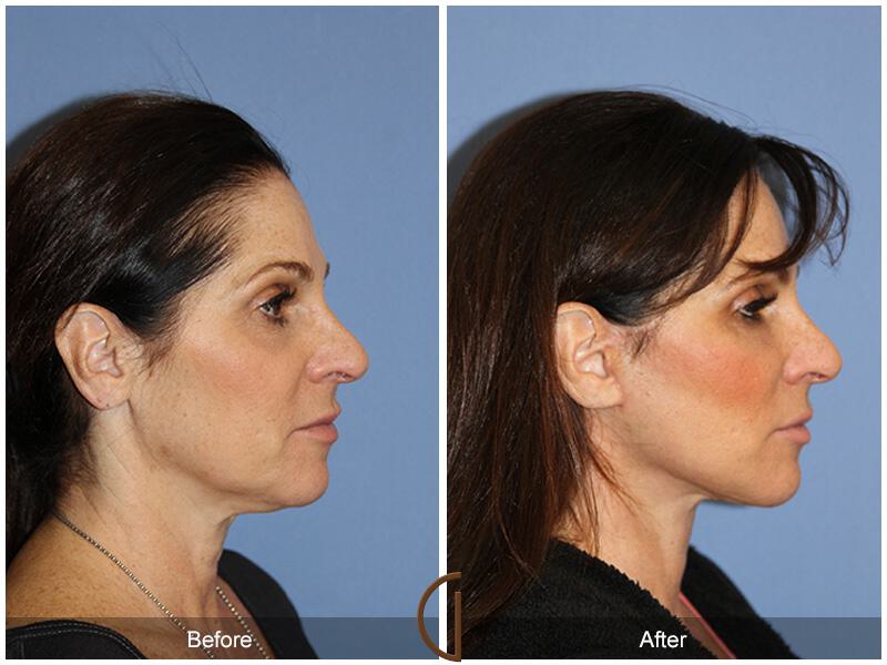 Facelift Fifties Before & After Photo