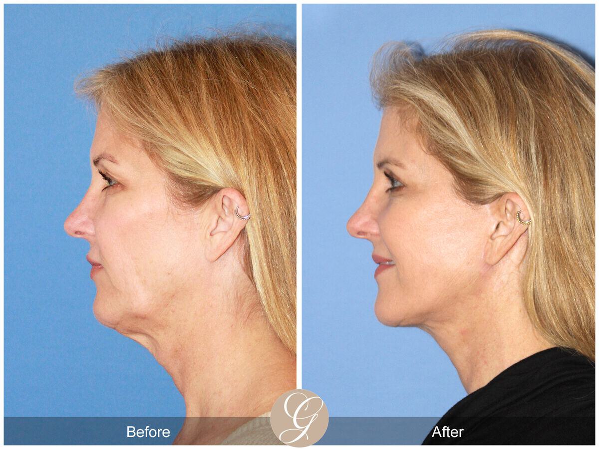 Facelift Fifties Before & After Photo