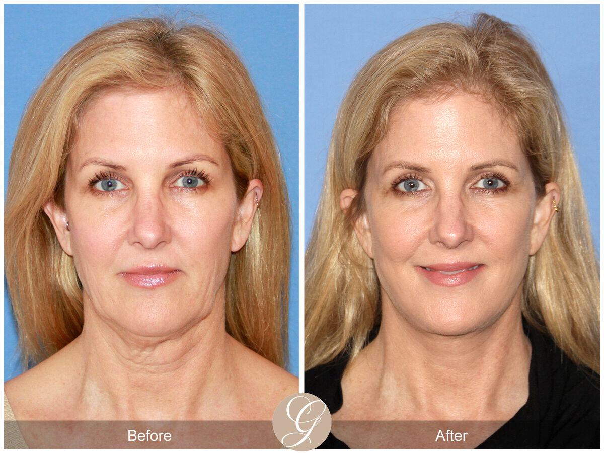 Facelift Fifties Before & After Photo