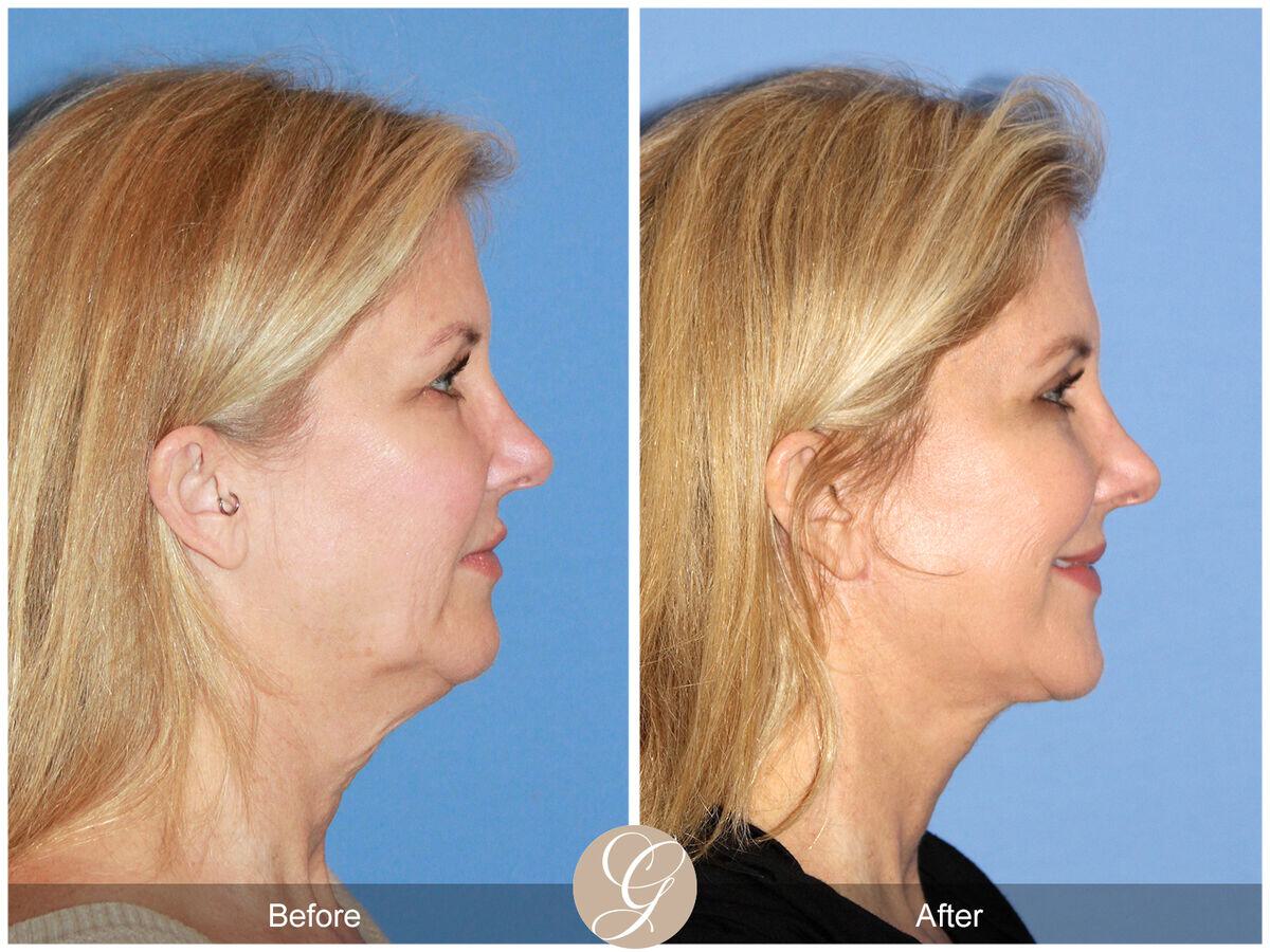 Facelift Fifties Before & After Photo