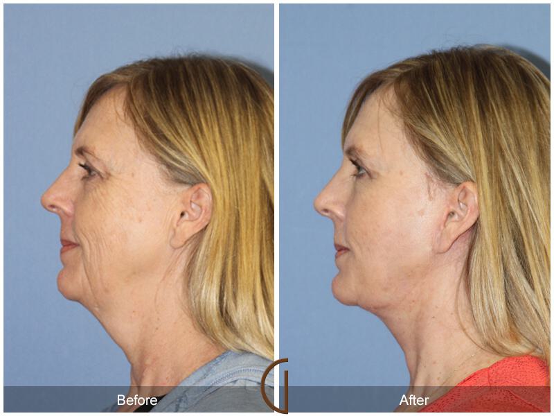 Facelift Fifties Before & After Photo