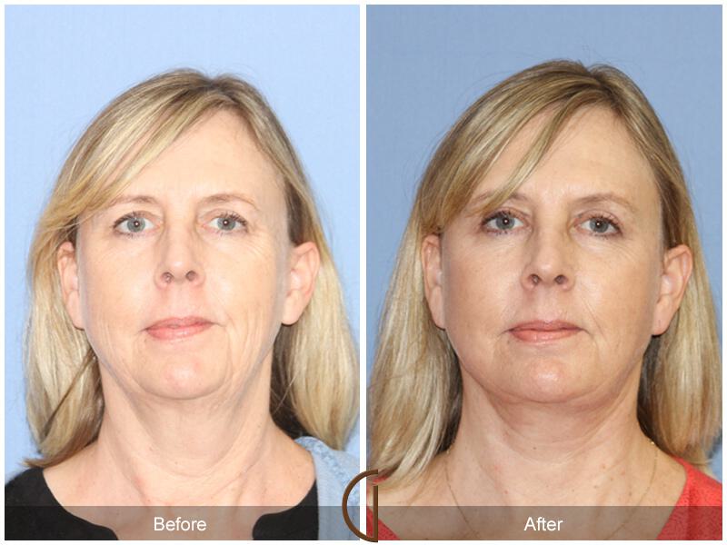 Facelift Fifties Before & After Photo