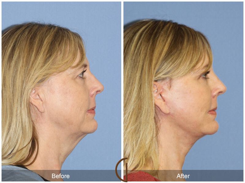 Facelift Fifties Before & After Photo