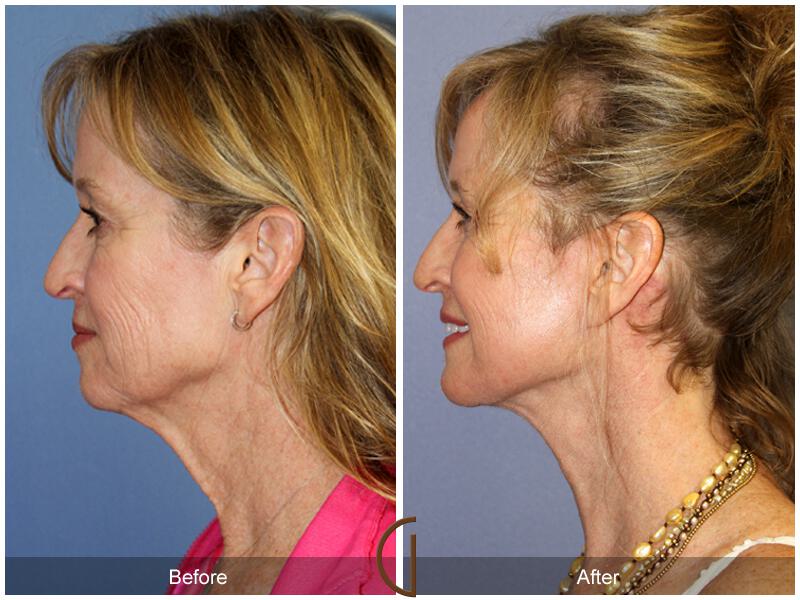 Facelift Fifties Before & After Photo