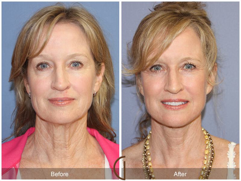 Facelift Fifties Before & After Photo