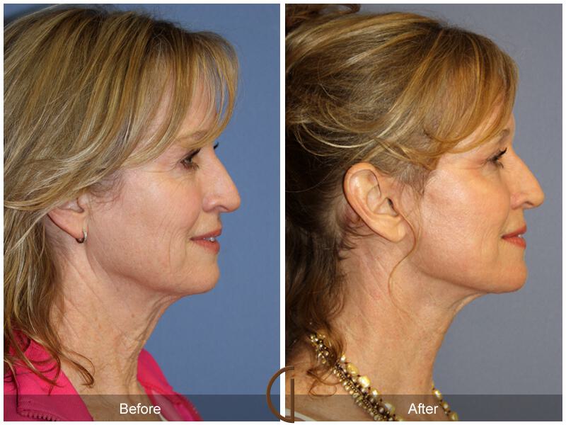 Facelift Fifties Before & After Photo